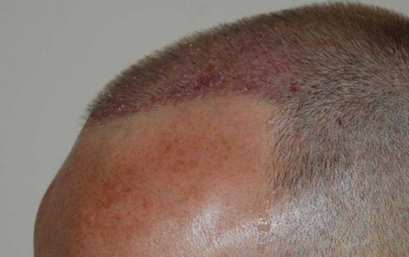 After hair transplant