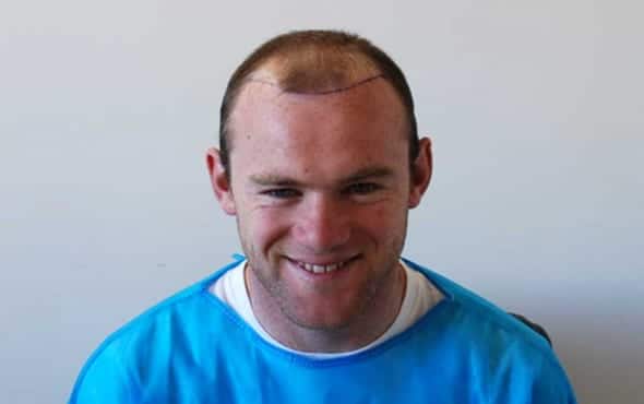 Wayne Rooney Hair Transplant